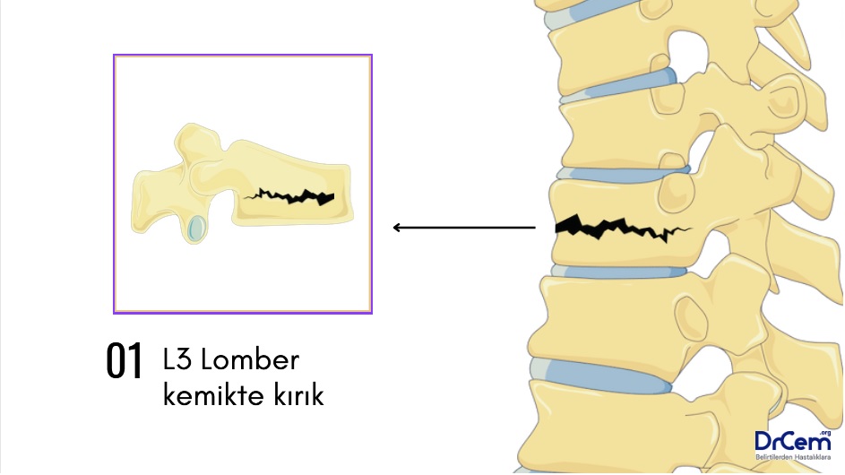 Vertebra Kırıkları görseli - DrCem hastalık rehberi